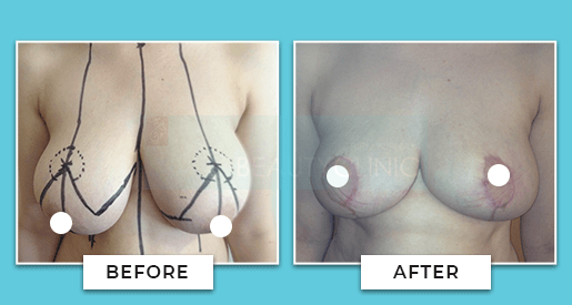 breast reduction before and after 1