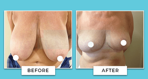 breast reduction before and after 2