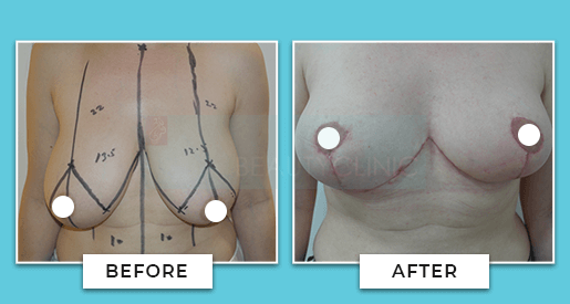 breast reduction before and after 3