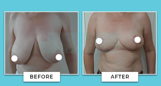 breast reduction before and after 4
