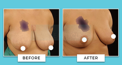 breast reduction before and after 5