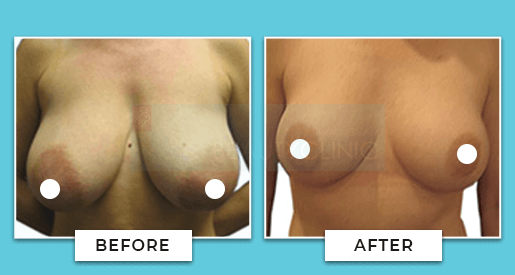 breast reduction before and after 6