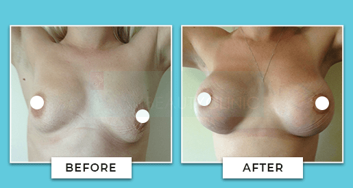 breast uplift before and after 1