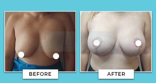 breast uplift before and after 2