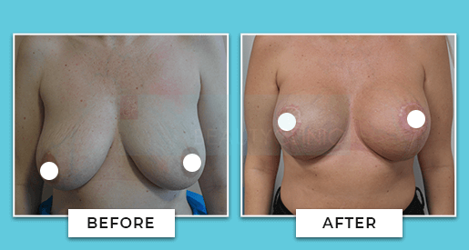 breast uplift before and after 3