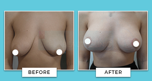 breast uplift before and after 4