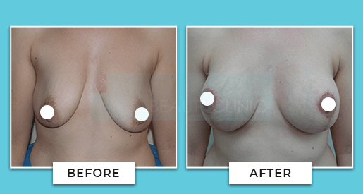 breast uplift before and after 5