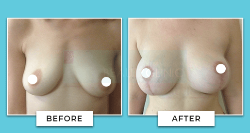 breast uplift before and after 6