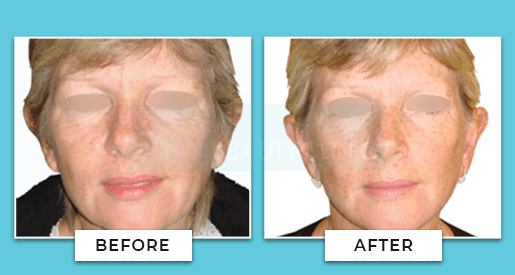 facelift before and after 1