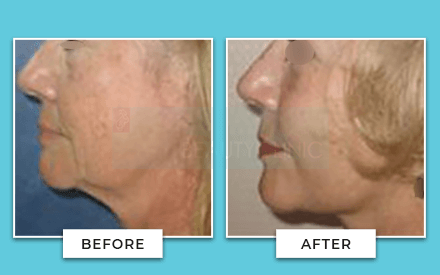facelift before and after 2