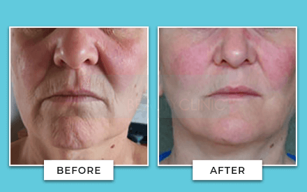 facelift before and after 3