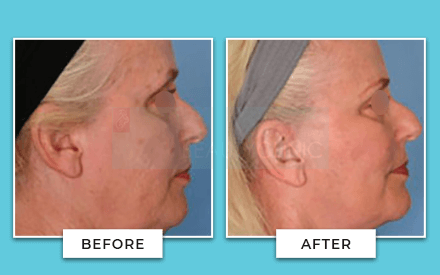 facelift before and after 4