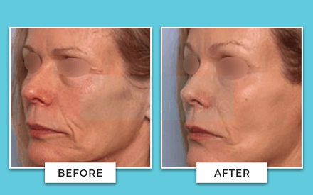 facelift before and after 5