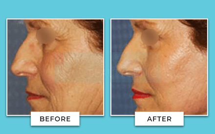 facelift before and after 6